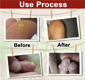 corn removal plaster corn removal plaster