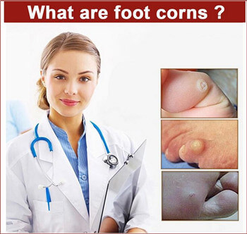 wart removal plaster wart removal plaster